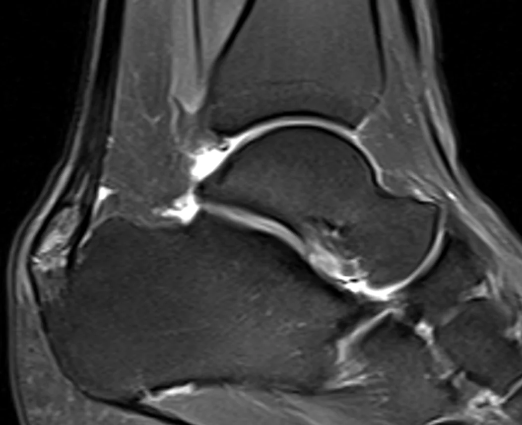 MRI of the Achilles tendon
