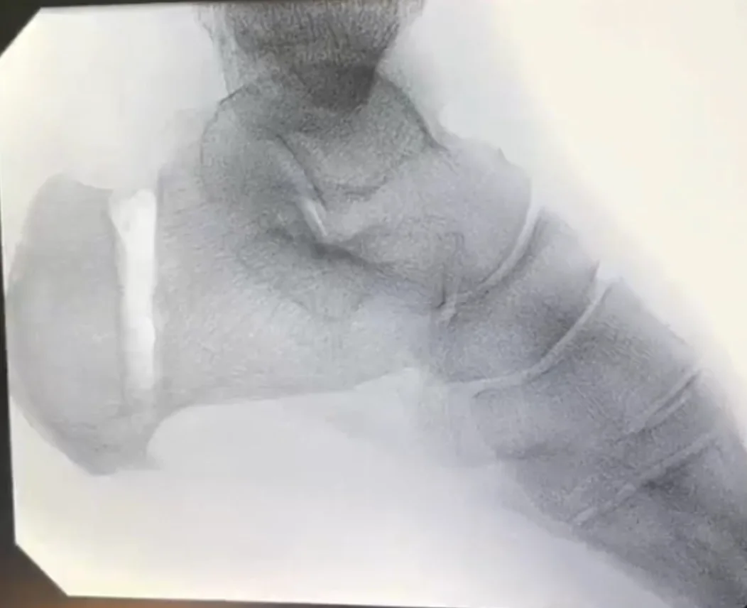 X-ray of the heel