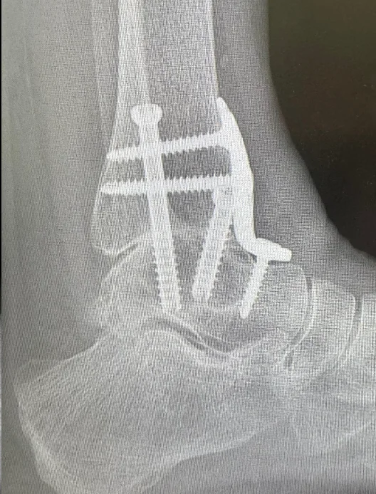 X-ray after ankle fusion with screws