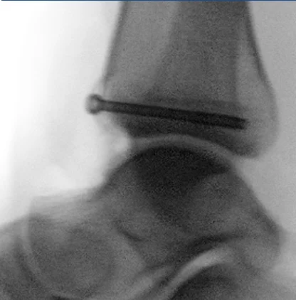 X-ray after avulsion fixation and ligament repair