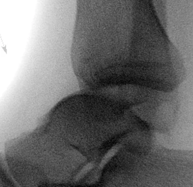 X-ray showing a syndesmotic ligament avulsion