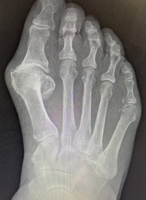 Bare feet showing the big toes