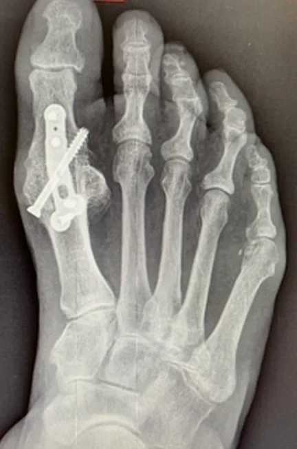 X-ray after big toe fusion with a plate and screws