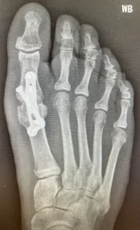 X-ray after big toe joint fusion with plate
