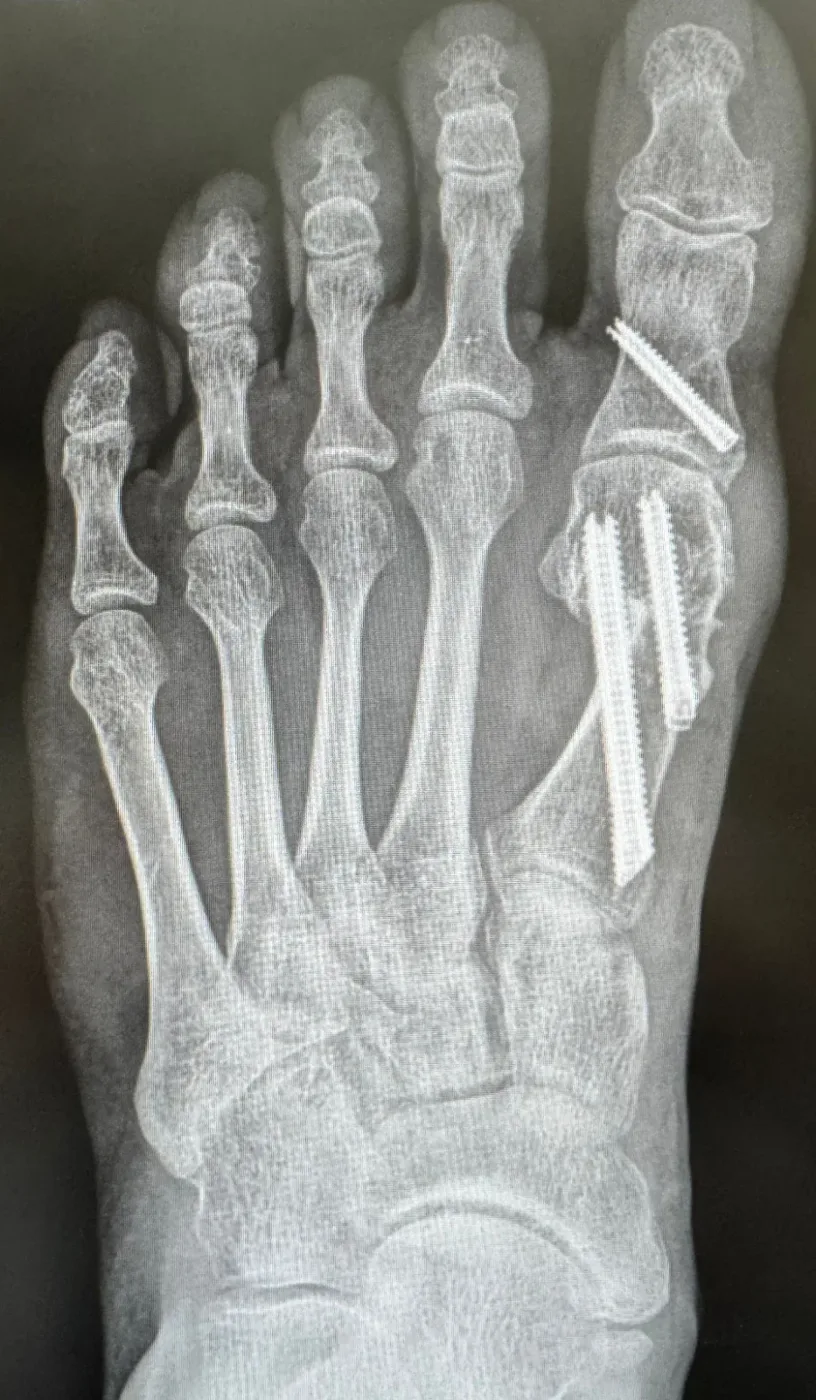 X-ray after keyhole bunion correction