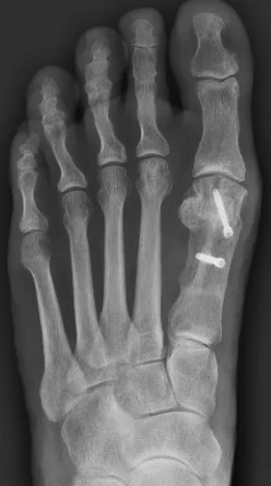 X-ray after Scarf osteotomy fixed with two screws