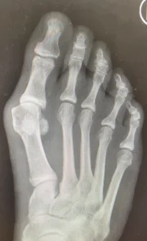 X-ray of a severe bunion