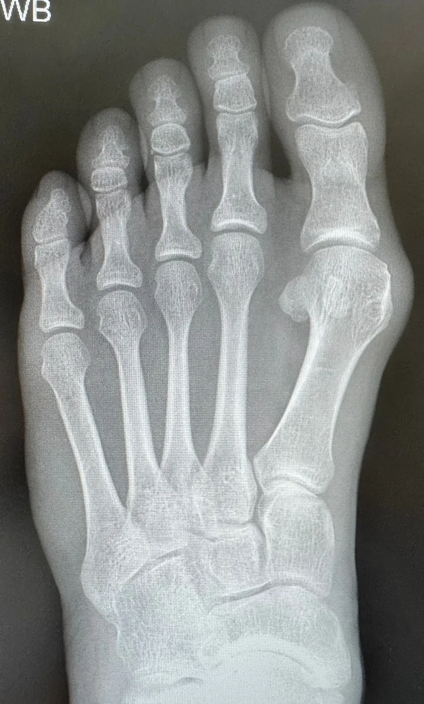 X-ray of a bunion before keyhole surgery