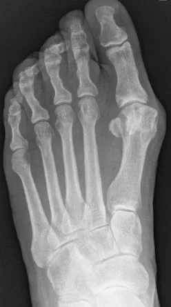 X-ray of a bunion before surgery