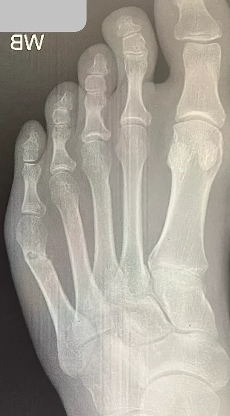 X-ray after keyhole bunionette correction