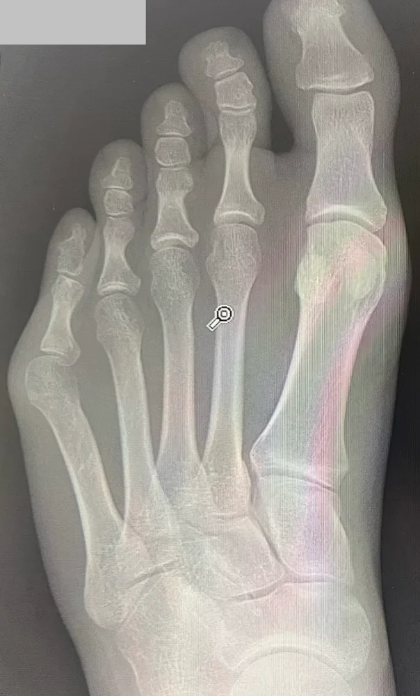 X-ray of a bunionette