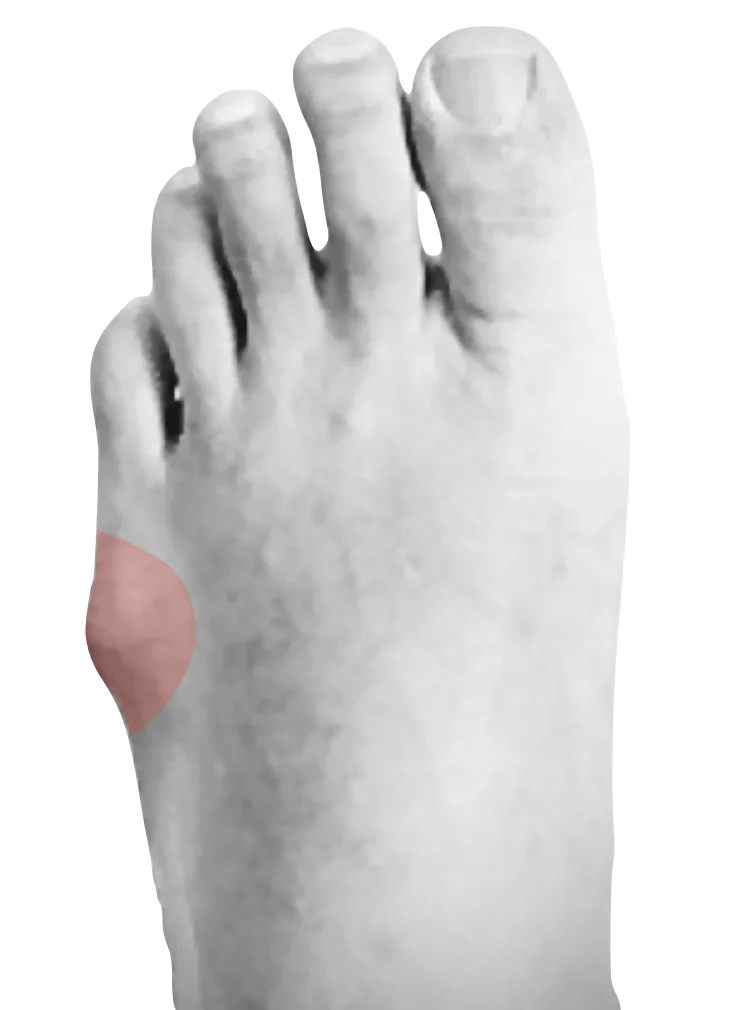 Foot with a bunionette at the base of the little toe
