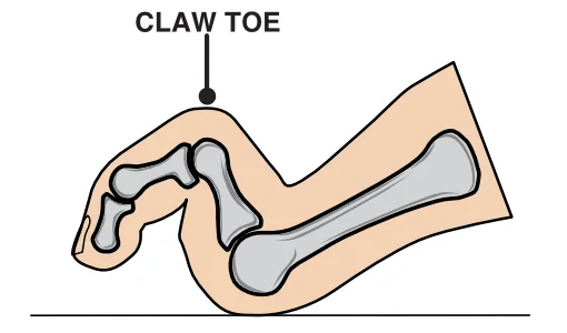 Diagram of a claw toe