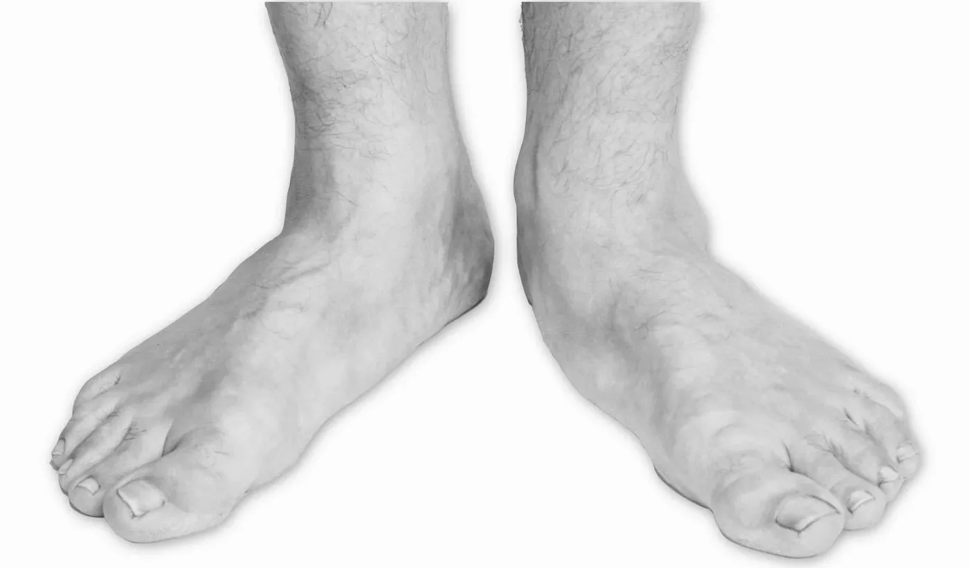 Pair of flat feet seen from the front