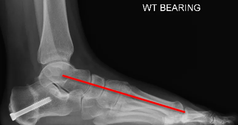 Side X-ray after flat foot reconstruction