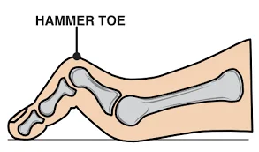 Diagram of a hammer toe bent at the middle joint