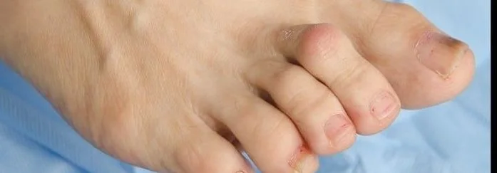 Foot after lesser toe correction