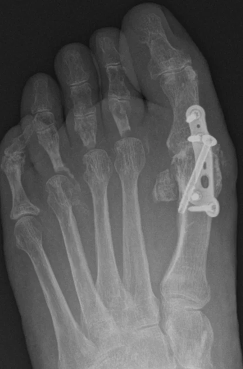 X-ray after big toe fusion and lesser toe correction