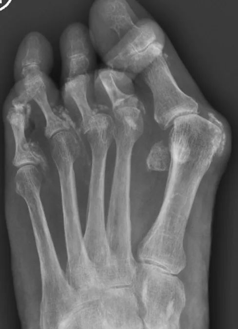 X-ray of severe inflammatory toe deformity
