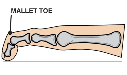 Diagram of a mallet toe bent at the end joint