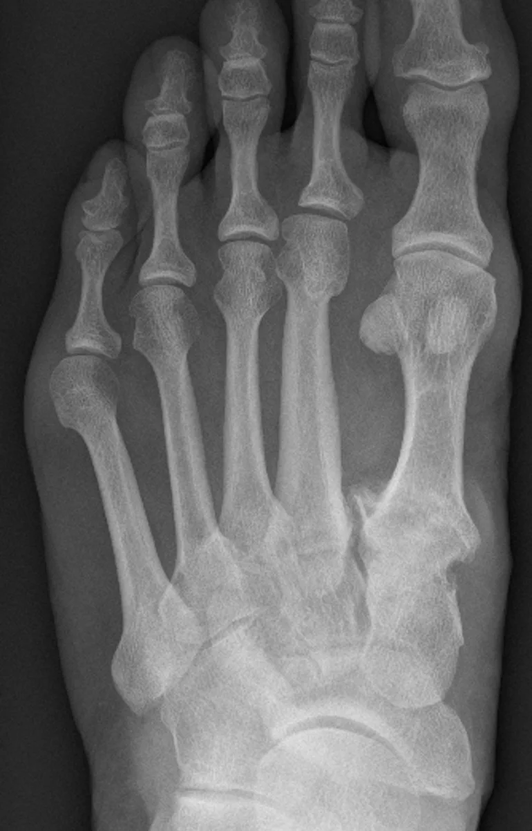 X-ray of midfoot arthritis