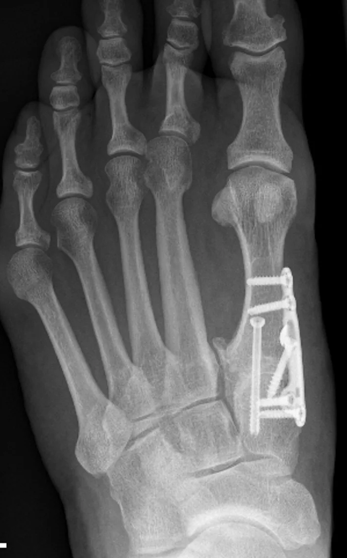 X-ray after first tarsometatarsal joint fusion