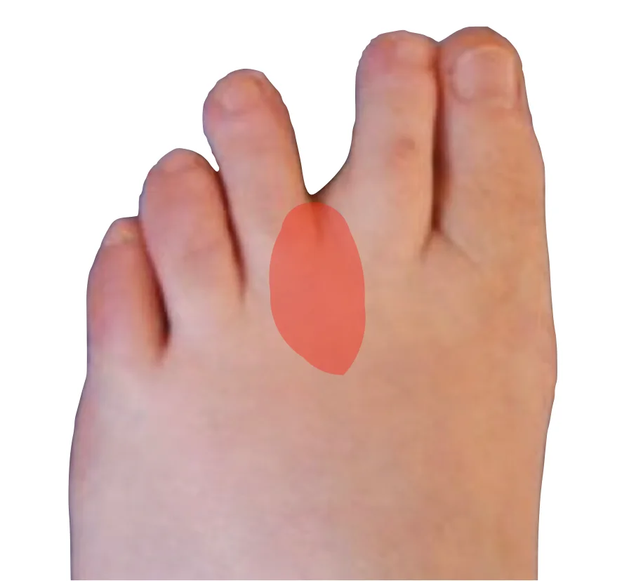 Diagram of a Morton's neuroma between the toes