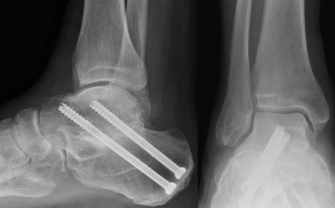 X-ray after subtalar fusion