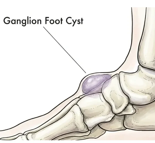 Foot with a lump on the top