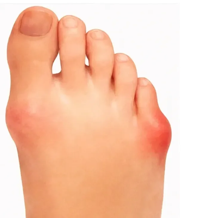 X-ray after bunionette correction