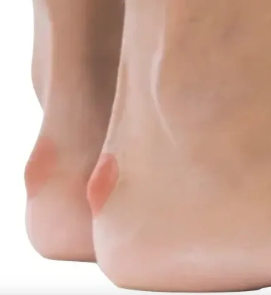 X-ray of the heel showing a Haglund's bump
