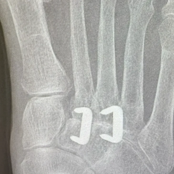 X-ray after midfoot fusion